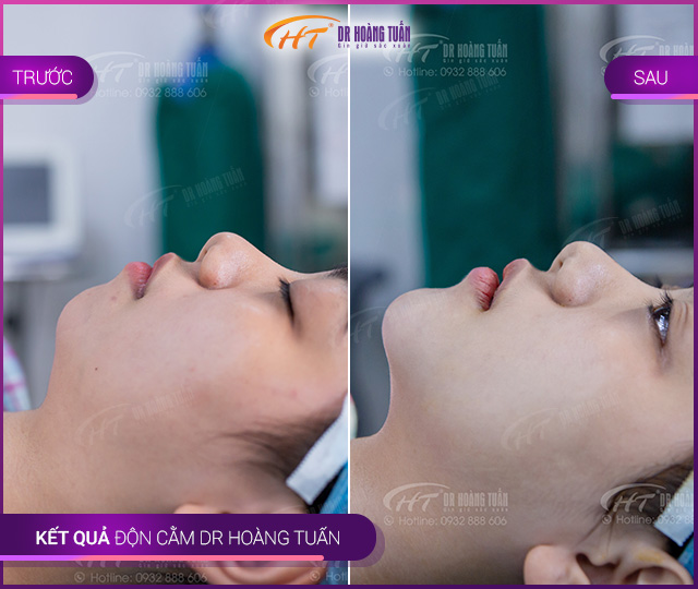 Kết quả độn cằm V Line Thẩm mỹ Hoàng Tuấn